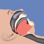 open airway therapy